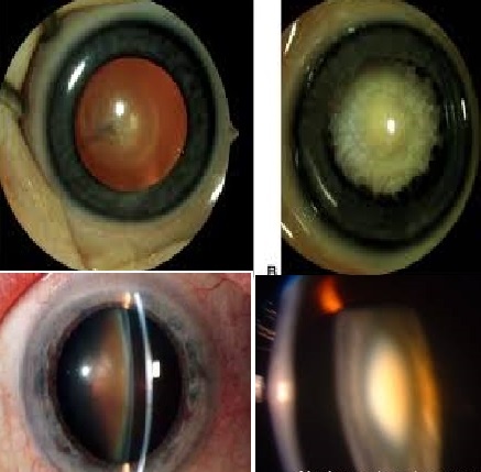 Immature Cataract4