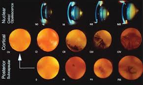 Immature Cataract6